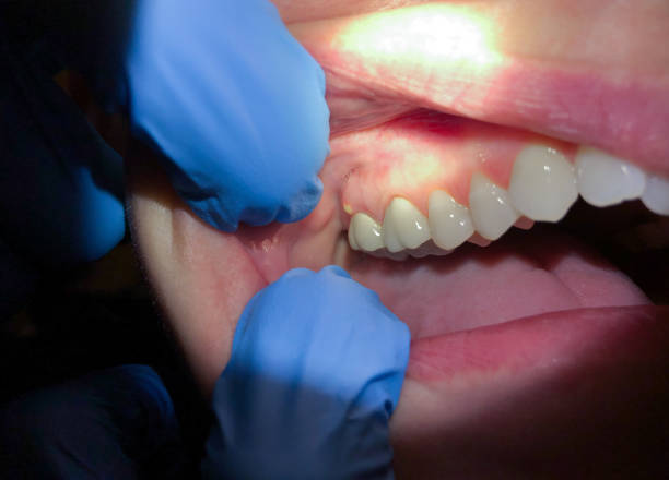 Best Emergency Treatment for Dental Infections or Abscesses in Dunstan, ME